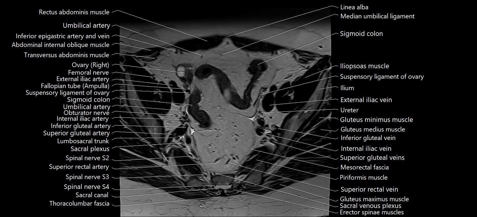 Axial cross sectional anatomy of female pelvis (MRI 3T) image 10.webp